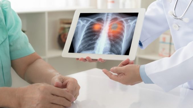 akciger kanseri nedir belirtileri ve tedavi yontemleri akciger kanseri nedir belirtileri ve tedavi yontemleri