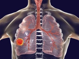 akciger kanserinde olum oranlari giderek azaliyor