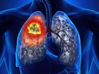 akciger kanserinin yan etkilerine pulmoner rehabilitasyon