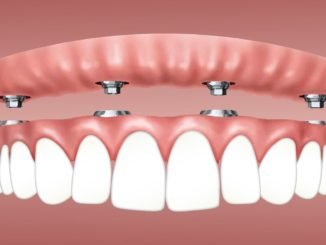 dis implantlari sizin icin uygun mu