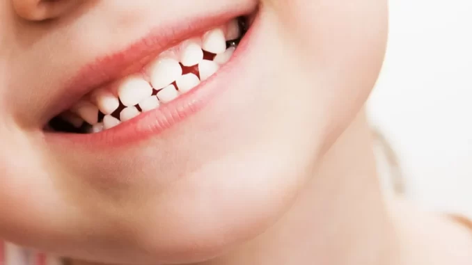 cocuklarda-dis-curuklerinin-nedenleri-alinmasi-gereken-onlemler-zKfnYrxN.webp